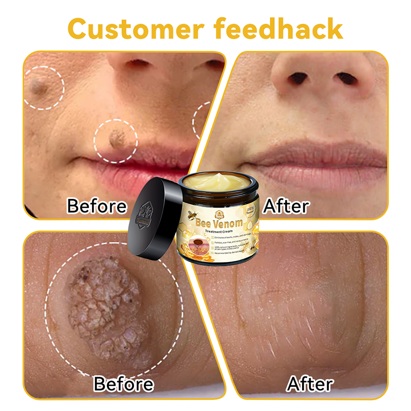 Turonu™ Bee Venom Skin Cream 🍄Approved by the Canadian Academy of Dermatology (CDA and FDA) (helps treat acne, warts, rosacea, psoriasis, age spots, eczema, and reduces the appearance of stretch marks)