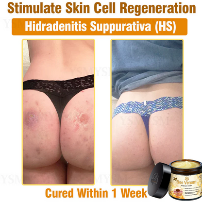 Official Store: Turonu™ Bee Venom Skin Treatment Cream Canadian Dermatology Association(CDA) Approved(Helping with acne, wart, rosacea, psoriasis, age spots, eczema, and reducing the appearance of stretch marks)💥