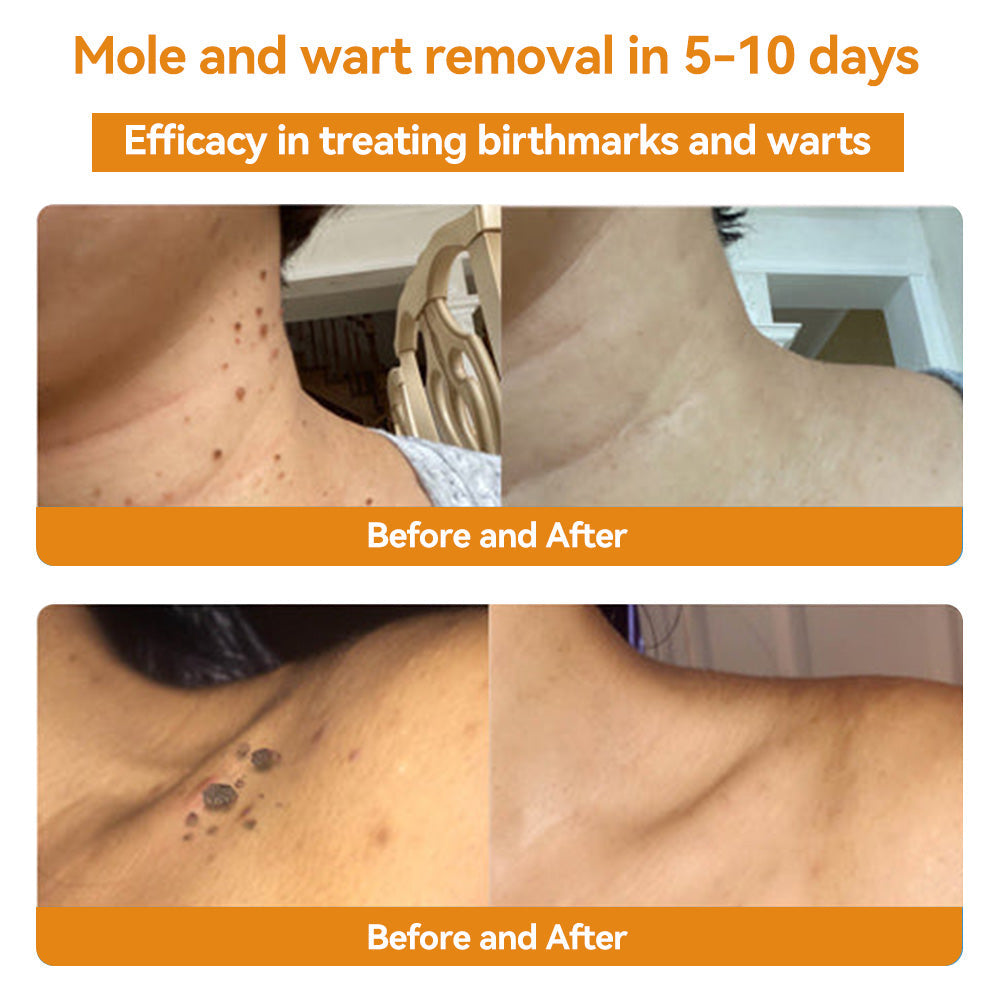 Official Store: Turonu™ Bee Venom Skin Treatment Cream Canadian Dermatology Association(CDA) Approved(Helping with acne, wart, rosacea, psoriasis, age spots, eczema, and reducing the appearance of stretch marks)💥