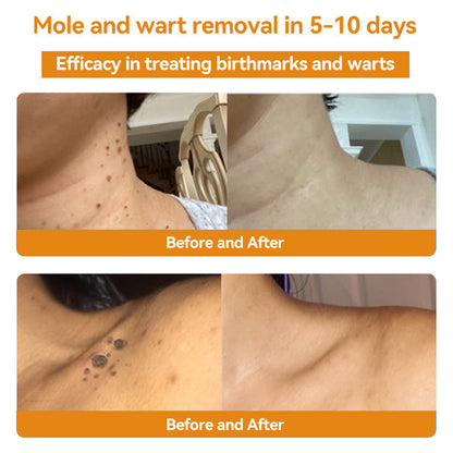 Official Store: Turonu™ Bee Venom Skin Treatment Cream Canadian Dermatology Association(CDA) Approved(Helping with acne, wart, rosacea, psoriasis, age spots, eczema, and reducing the appearance of stretch marks)💥