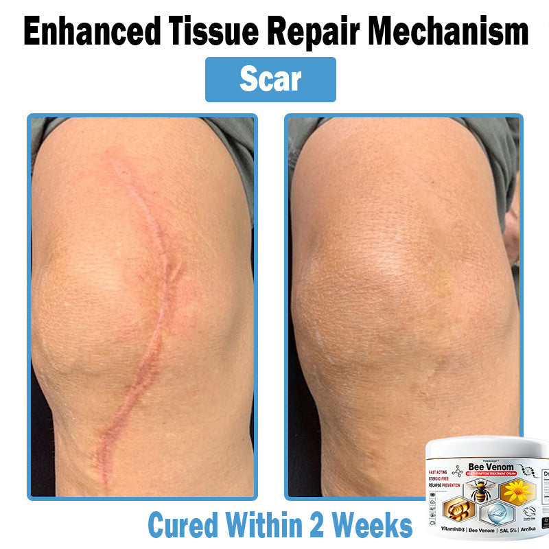 TODAHOF™ Bee Venom Multi-Symptom Skin Treatment Cream (👨‍⚕CDA RECOMMENDS)