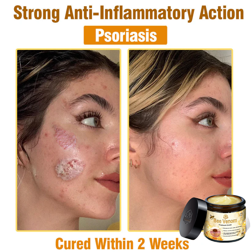 Official Store: Turonu™ Bee Venom Skin Treatment Cream Canadian Dermatology Association(CDA) Approved(Helping with acne, wart, rosacea, psoriasis, age spots, eczema, and reducing the appearance of stretch marks)💥