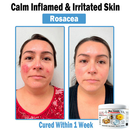 TODAHOF™ Bee Venom Multi-Symptom Skin Treatment Cream (👨‍⚕CDA RECOMMENDS)