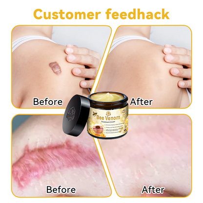Turonu™ Bee Venom Skin Cream 🍄Approved by the Canadian Academy of Dermatology (CDA and FDA) (helps treat acne, warts, rosacea, psoriasis, age spots, eczema, and reduces the appearance of stretch marks)