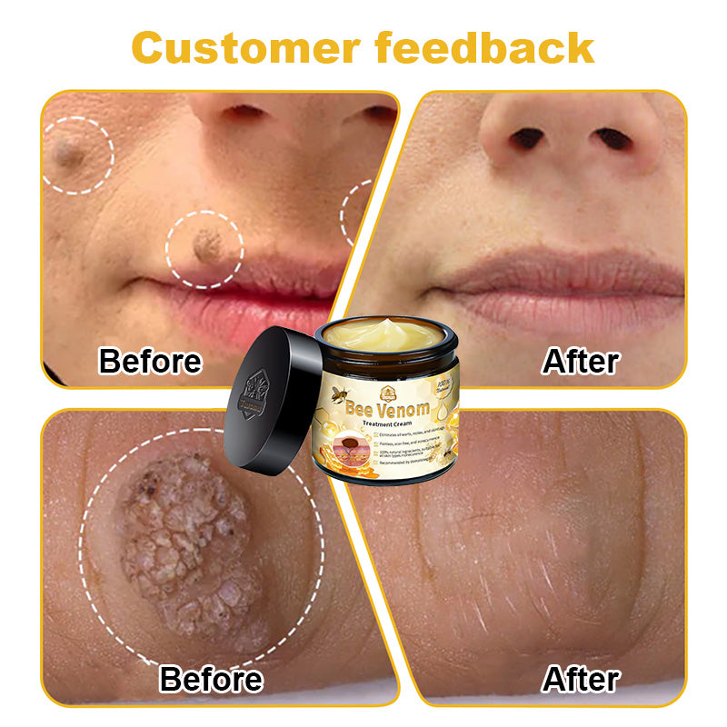 Official Store: Turonu™ Bee Venom Skin Treatment Cream Canadian Dermatology Association(CDA) Approved(Helping with acne, wart, rosacea, psoriasis, age spots, eczema, and reducing the appearance of stretch marks)💥