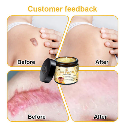 Official Store: Turonu™ Bee Venom Skin Treatment Cream Canadian Dermatology Association(CDA) Approved(Helping with acne, wart, rosacea, psoriasis, age spots, eczema, and reducing the appearance of stretch marks)💥