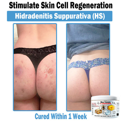 TODAHOF™ Bee Venom Multi-Symptom Skin Treatment Cream (👨‍⚕CDA RECOMMENDS)
