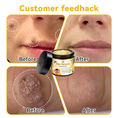 Turonu™ Bee Venom Skin Cream 🍄Approved by the Canadian Academy of Dermatology (CDA and FDA) (helps treat acne, warts, rosacea, psoriasis, age spots, eczema, and reduces the appearance of stretch marks)