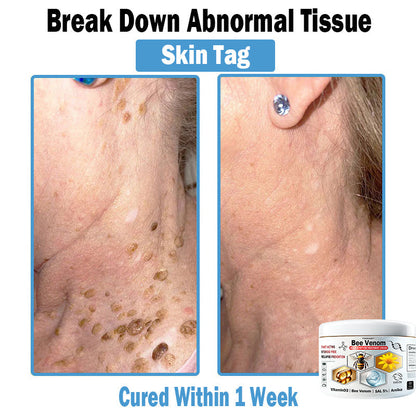 TODAHOF™ Bee Venom Multi-Symptom Skin Treatment Cream (👨‍⚕CDA RECOMMENDS)