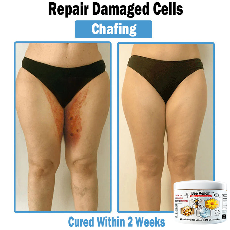 TODAHOF™ Bee Venom Multi-Symptom Skin Treatment Cream (👨‍⚕CDA RECOMMENDS)