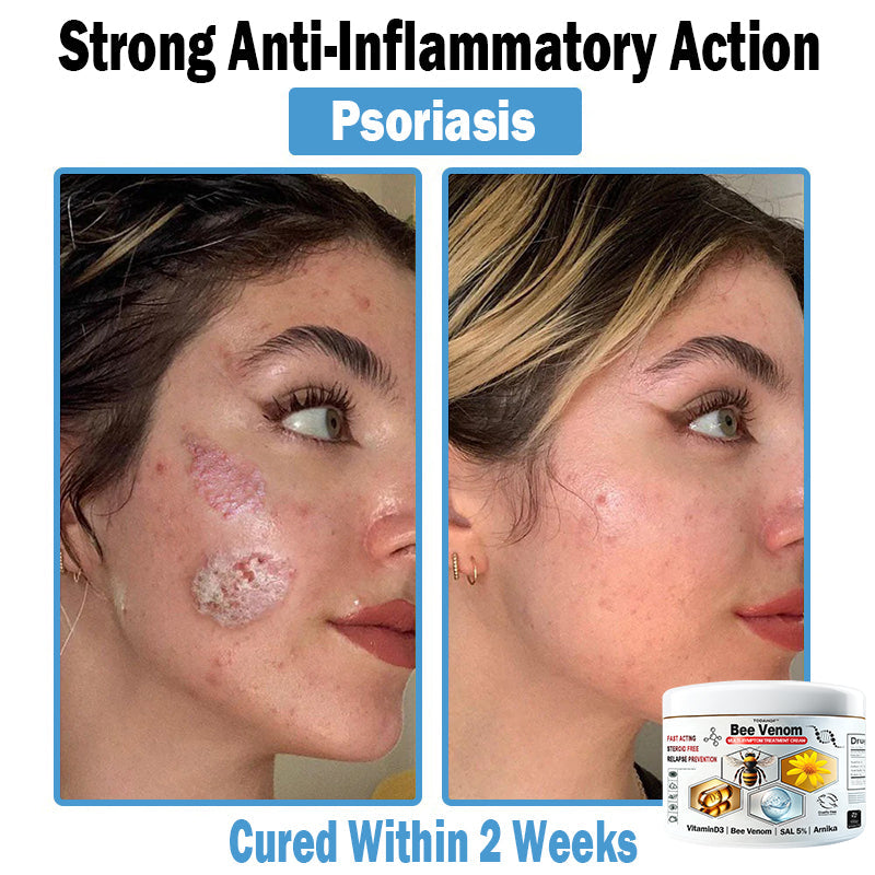 TODAHOF™ Bee Venom Multi-Symptom Skin Treatment Cream (👨‍⚕CDA RECOMMENDS)
