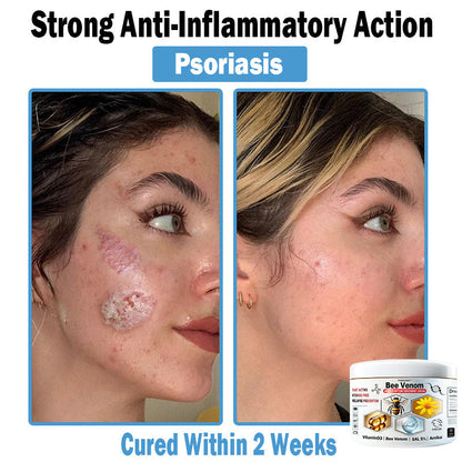TODAHOF™ Bee Venom Multi-Symptom Skin Treatment Cream (👨‍⚕CDA RECOMMENDS)